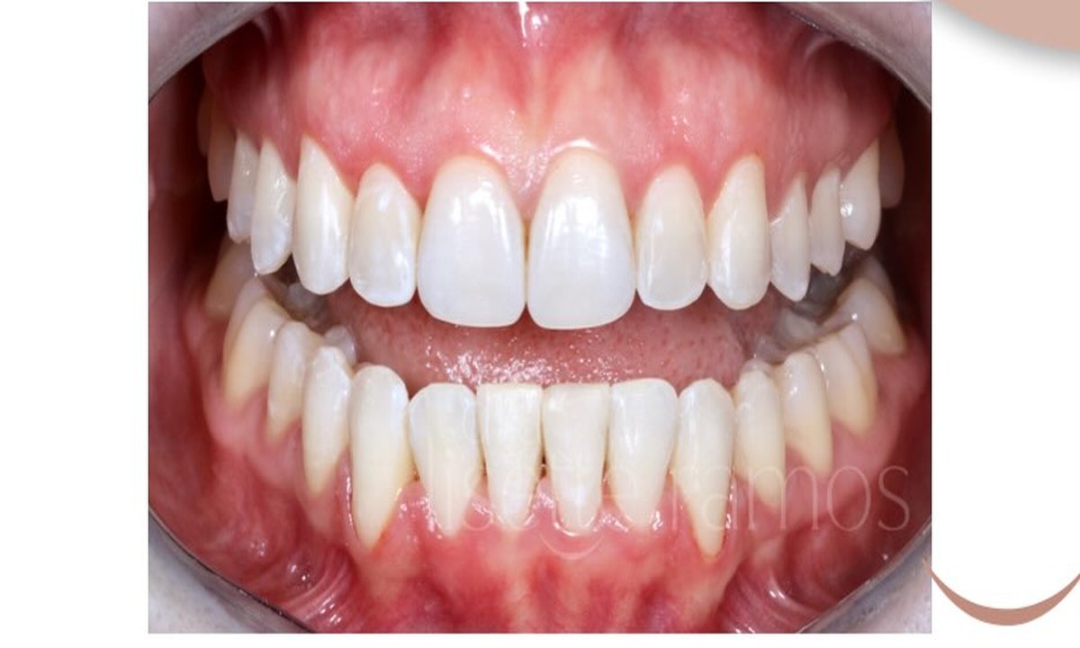Después del tratamiento